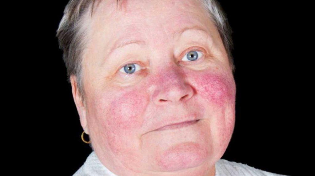 What Is An Alcoholic Nose Or Drinker's Nose (Rhinophyma)? - Addiction