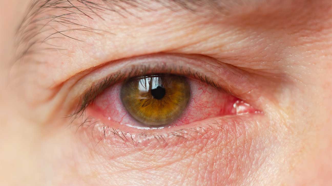 Cocaine Eyes - What Does Cocaine Do To Your Eyes?