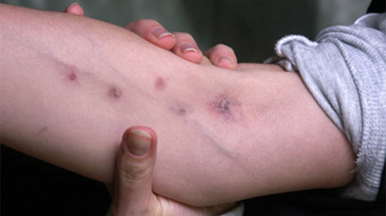 What Do Heroin Addict Arms Look Like?