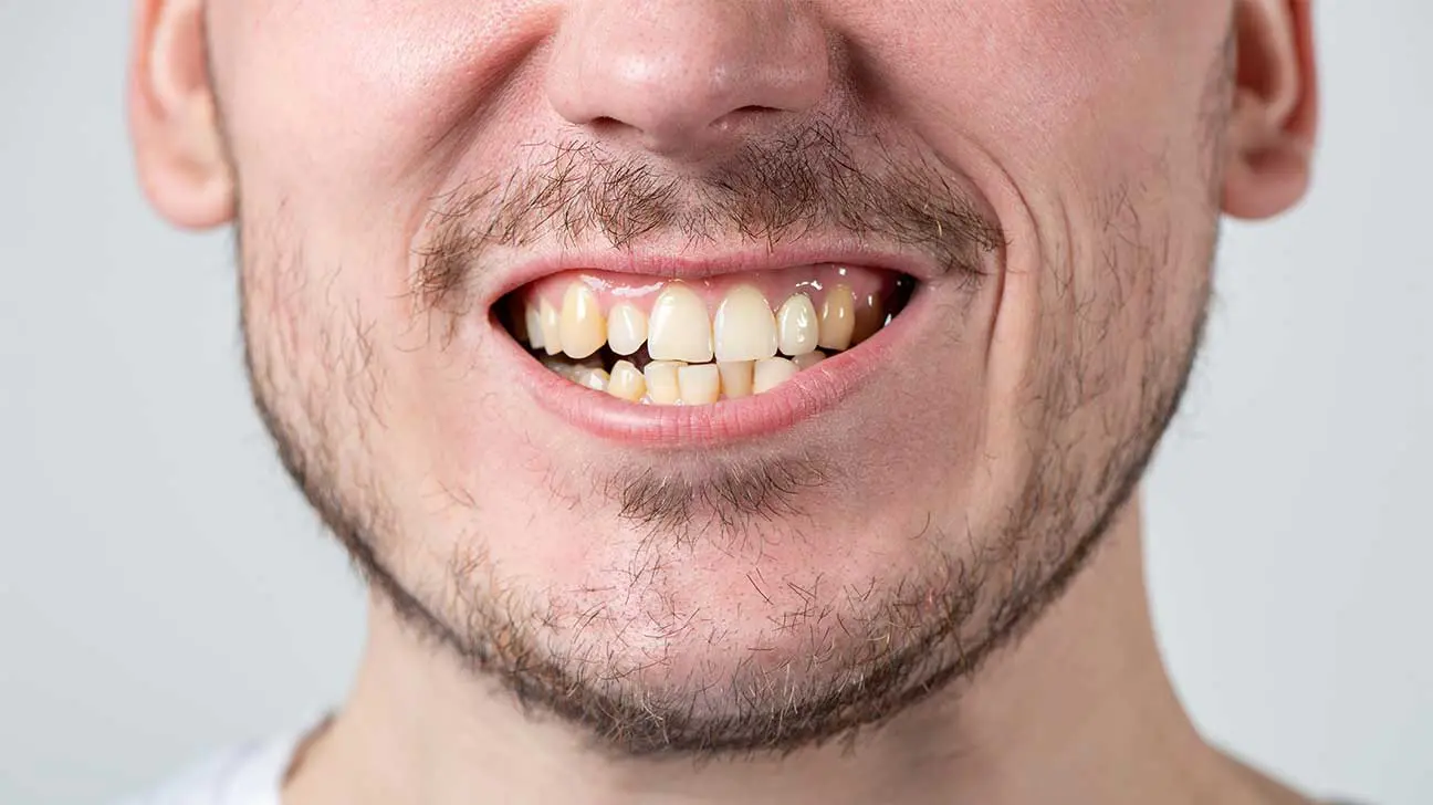 Does Suboxone Rot Your Teeth? - Suboxone Tooth Decay